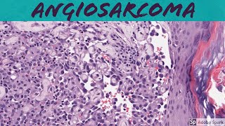 Angiosarcoma 5Minute Pathology Pearls [upl. by Sharon]