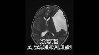 KYSYE ARACHNOIDIEN science femmemedecine radiologystudent info [upl. by Lerred]