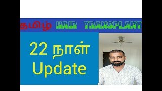 After 22 daysTamil FUE hair TransplantTamil Hair Transplant [upl. by Egwan]