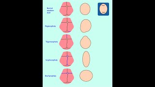 57 Варіанти й аномалії розвитку кісток черепа людини  AnatomUaAUDIO [upl. by Ttocserp446]