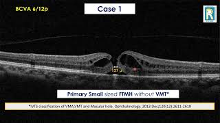 What causes a macular pucker [upl. by Rheims73]