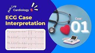 Abnormality in ECG Graph  Discussion about ECG Cases  ECG Cases for Students [upl. by Htiekal868]