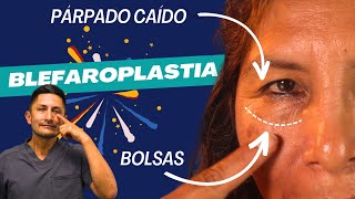 Cirugía de Bolsas y Párpados Caídos 👀BLEFAROPLASTIA Superior e Inferior 💙 Dr JAVIER CASTRO ROMERO [upl. by Radnaskela]