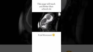 FETAL MOVEMENT😃 short youtubeshorts medical neet [upl. by Neersin]