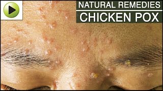 Skin Care  Chicken Pox  Natural Ayurvedic Home Remedies [upl. by Jezabella]