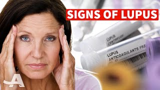 5 Early Signs of Lupus [upl. by Ahsieat]