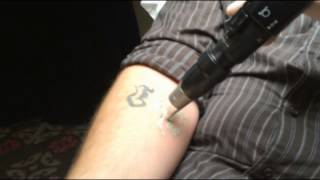 PicoSure Laser Tattoo Removal Demonstration in Toronto  SpaMedicaTV [upl. by Zielsdorf]