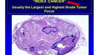 Prostate Cancer the Answers Are Here Focal Therapy HIFU 3TMRI and PCA3 HIFU909 [upl. by Evslin642]