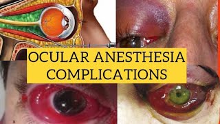 Complications of ocular anesthesia  Diagnosis and management [upl. by Rumit]