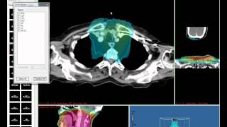 Fratoria Dicom RT Viewer  Part 1 [upl. by Llerreg]