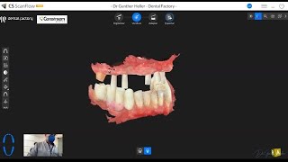 ScanFlow Premium Dexis Envista em Moldagens Complexas em Odontologia Digital [upl. by Mossolb327]