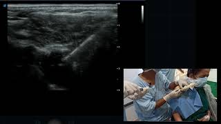 USG guided Shoulder Injection  Ultrasound guided spiration of subcoracoid bursa [upl. by Harmonia]