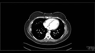 Abdominal Anatomy on Computed Tomography [upl. by Janine]