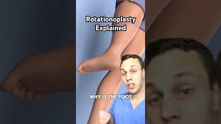 Why is the foot on backwards This is called a rotationplasty [upl. by Serica]