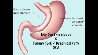 My Gastric Sleeve  Brachioplasty amp Tummy Tuck Surgery QampA [upl. by Karylin]