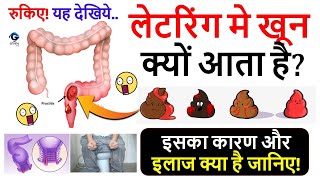 लेटरिंग मे खून क्यों आता है इसके कारणजाँच और इलाज देखिये  Blood In Stool  Gyanvid Nuskhe [upl. by Afnin]