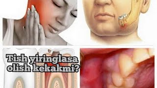 TISH YIRINGLASHI DAVOLASH PERIODONTID ТИШ ЙИРИНГЛАШИ ДАВОЛАШ ПЕРИОДОНТИД [upl. by Jarnagin540]