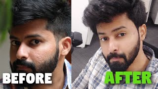 Minimise Large Pores  Acne Scars Control  முகத்தில் உள்ள பள்ளம் நீங்க இதைத்தான் செய்யனும் [upl. by Marijn]