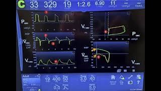 Analysis and Interpretation of Ventilator Graphics Including Loops [upl. by Sivrahc]