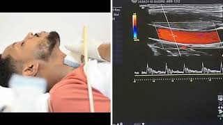 Carotid and Vertebral Arteries Doppler Ultrasound Protocols [upl. by Waylen204]