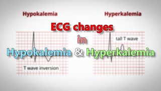 Hypokalemia and Hyperkalemia ECG changes [upl. by Hayyim]