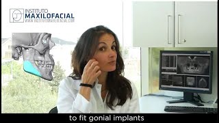 Gonial implants [upl. by Shakespeare]