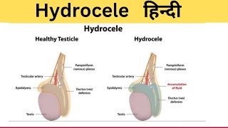 Hydrocele मे पानी भर गया हैँ  सूजन हैँ  Cause  Symptoms  Treatment  Hindi [upl. by Einhorn274]