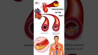 Cholesterol In The Body medical animation 3d short BiologywithAliya [upl. by Gifferd312]