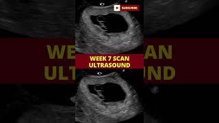 ultrasound scan week 7  pregnancy scan  week by week pregnancy [upl. by Ariamo735]