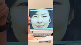 Double Eyelid Surgery  Eyelid Surgery  Plastic Surgery Before amp After Transformation [upl. by Hcaz]