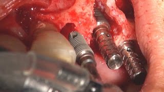 Multiple implantation using Dentium Implant Guide kit [upl. by Wilfred]