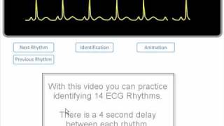 ECG Rhythm Review of 14 common rhythms [upl. by Intyre]