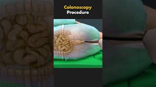 COLONOSCOPY PROCEDURE [upl. by Gnoud]