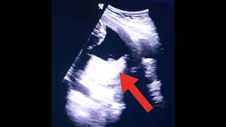 Low placenta in pregnancy  placenta previa  Anterior posterior placenta  Low lying placenta usg [upl. by Annayad]