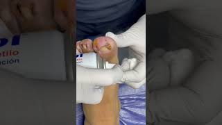 podologo ingrowntoenailsurgery satisfying onicocriptosis uñas [upl. by Halle]