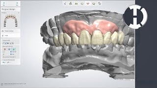 3Shape Study Club  Design Challenge 1  DentalTechTips [upl. by Ahsenid83]