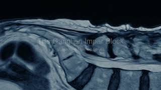 PainExam US Guided Ganglion Impar Block Coccygodynia Pelvic amp Perineal Pain David Rosenblum MD [upl. by Johanan699]