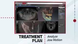 SICAT Function  Track real motion in motion [upl. by Atteras]