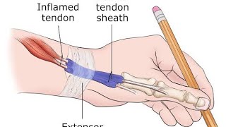 De quarvain Tenosynovitis Surgery Animation3D Animation [upl. by Tarah752]