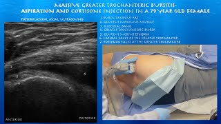 Ultrasound Guided Massive Greater Trochanteric Bursitis Aspiration and Injection by probeultrasound [upl. by Mile]