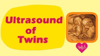 Sonography of Twins [upl. by Lindley934]