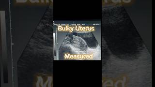 Bulky Uterus  Heterogenous Variable Texture of Uterus  Ovarian Cysts  Adnexa Cyst on Ultrasound [upl. by Helmer]