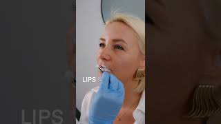 quotNaturallookquot the lipfiller technique with stunning results [upl. by Philbrook]