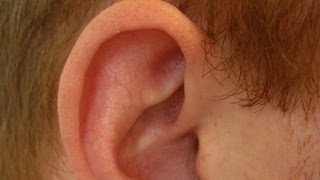 Determine If Ear Cartilage Is Infected  Ear Problems [upl. by Nosnibor388]