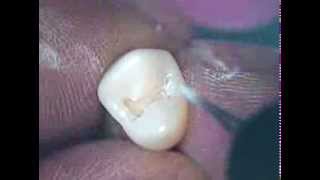 Class II tooth preparation tooth number 12 [upl. by Jeremie]