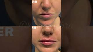 Before and after lip filler at Beverly Hills Wellness Center amp Med Spa Florida shorts [upl. by Huntley]