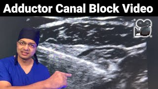 ADDUCTOR CANAL BLOCK Ultrasound Video  Saphenous nerve amp Nerve to Vastus Medialis  NVM Block [upl. by Eceirehs663]