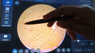 Hard exudates Haemorrhage How Diabetic effect the eyes Fundus examination optometry [upl. by Olbap873]