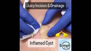 Inflamed Cyst Incision amp Drainage [upl. by Lenzi]