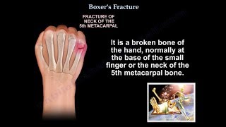 Boxers Fracture  Everything You Need To Know  Dr Nabil Ebraheim [upl. by Marasco]